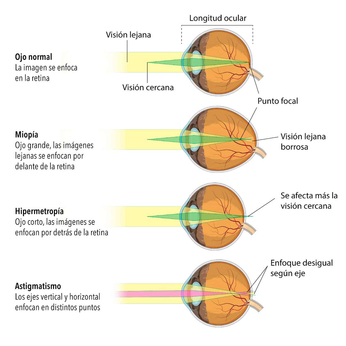 Il·lustració de diferents casos d'Ametropies